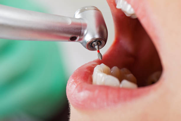 Best Knocked-Out Tooth Emergency  in Sea Ranch, CA